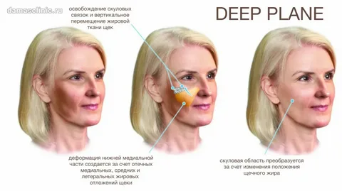 SMAS Facelift vs Deep Plane Facelift